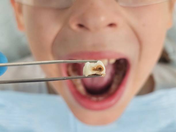 Emergency Dental Filling Replacement in SC